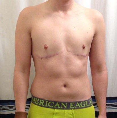 2 years post top surgery