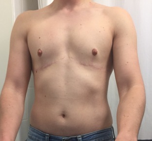 4.5 years post top surgery